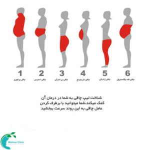 انواع چاقی در مردان و زنان