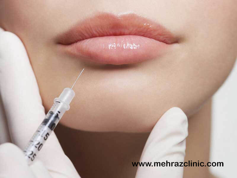 آشنائی با تکنیک تزریق ژل لب  Lip injection: