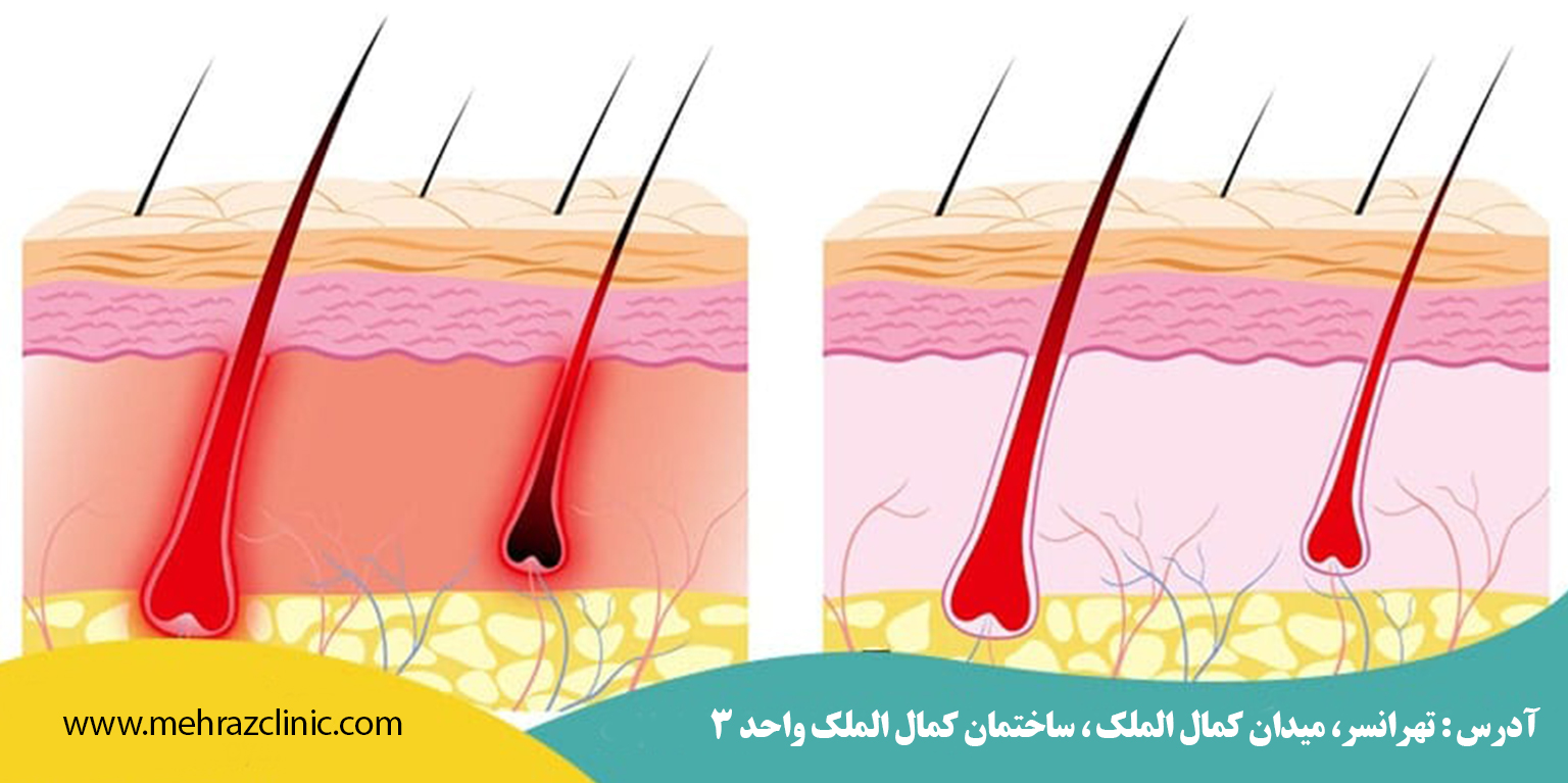 ۶ عامل موثر برای تقویت فولیکول مو