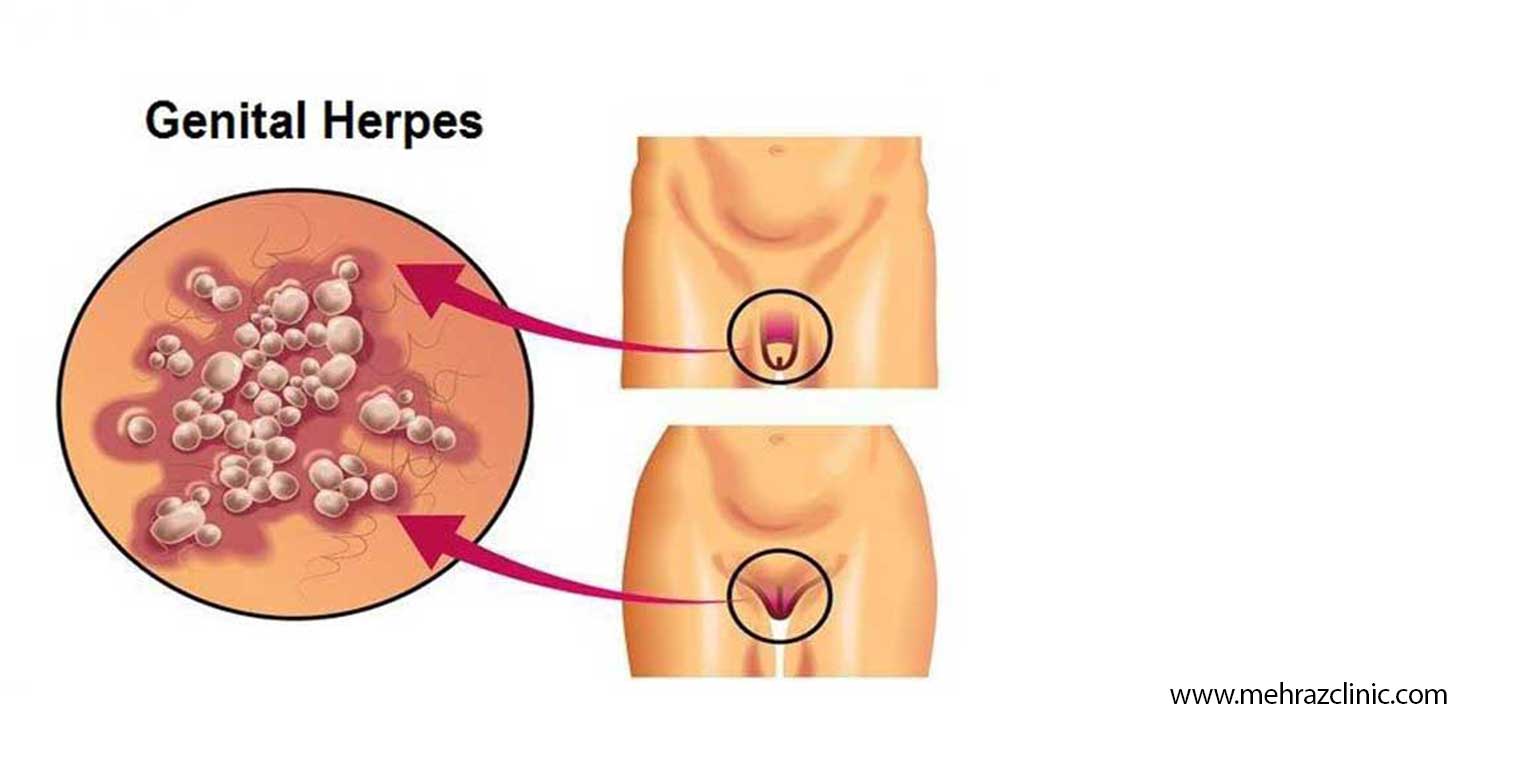مقایسه درمان با لیزر یا کرایو تراپی